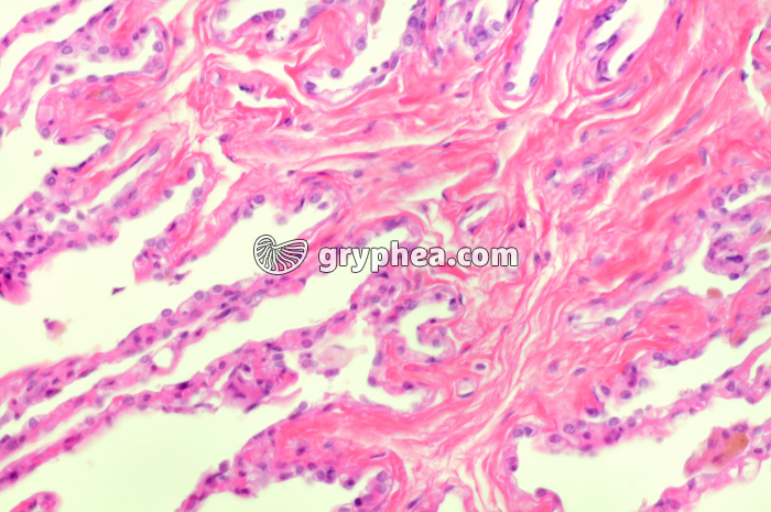 Emphysème pulmonaire x100 - gryphea.org